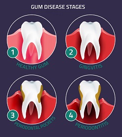 stages of gum infection Periodontitis Frederick, MD