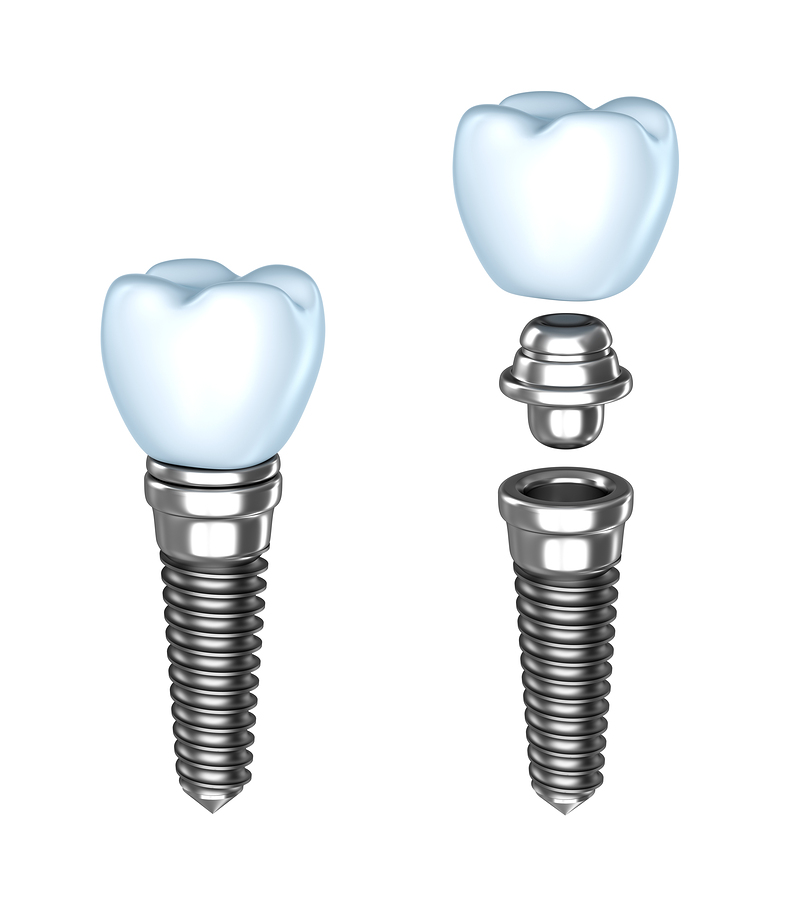 assembly of dental implant crown Frederick, MD