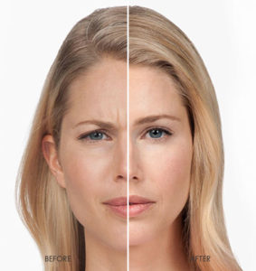 Botox Before and After - Frederick, MD - PearlFection Dentistry
