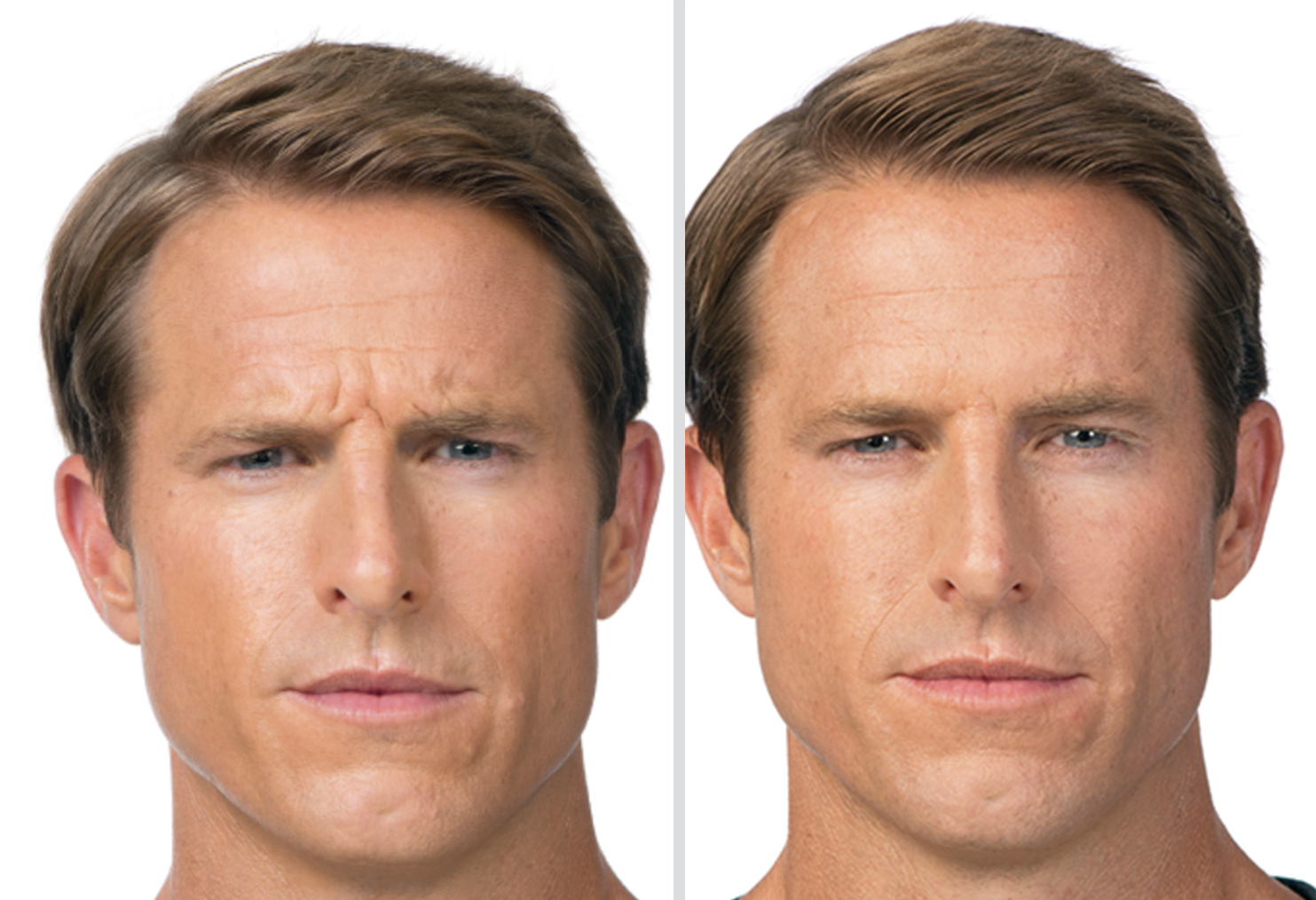 Botox for Men in Frederick Maryland