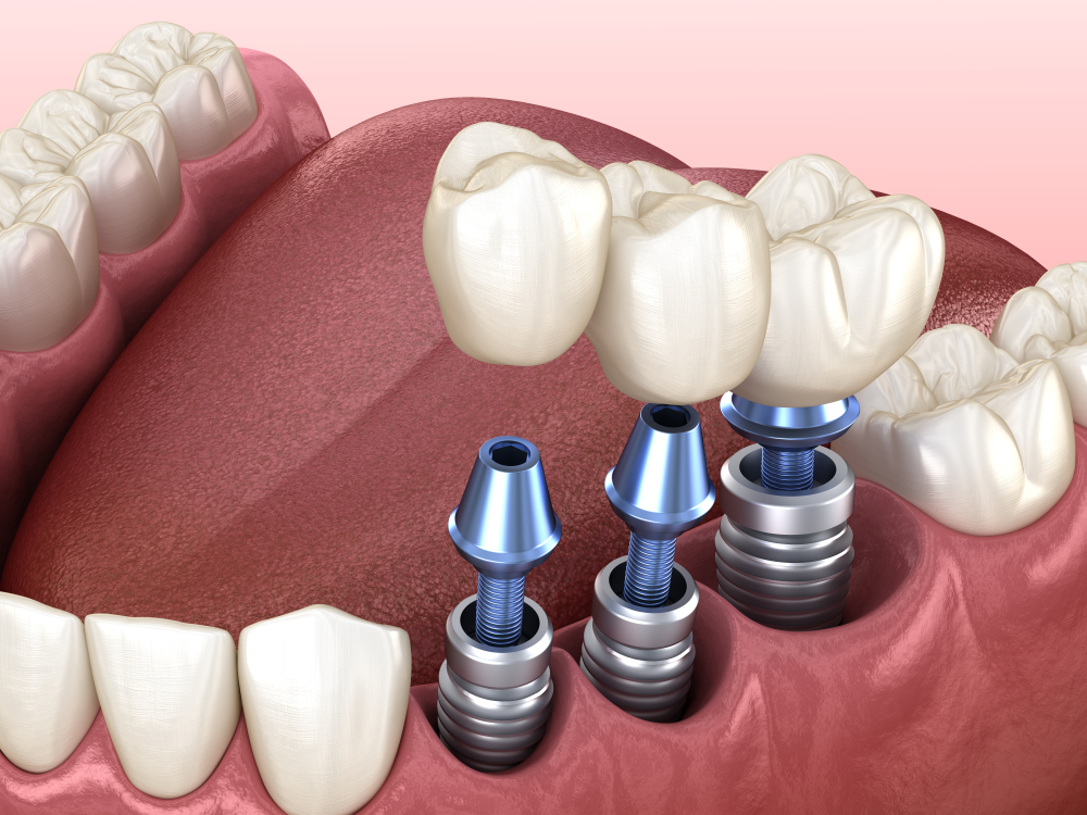 dental implants Frederick, MD